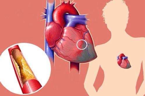 කොලෙස්ටරෝල් නිසා බයෙන්ද ඉන්නේ ? මෙන්න එහෙනම් කොලෙස්ටරෝල් මට්ටු කරන දිව්‍යමය ඖෂධ ගුලියක්…
