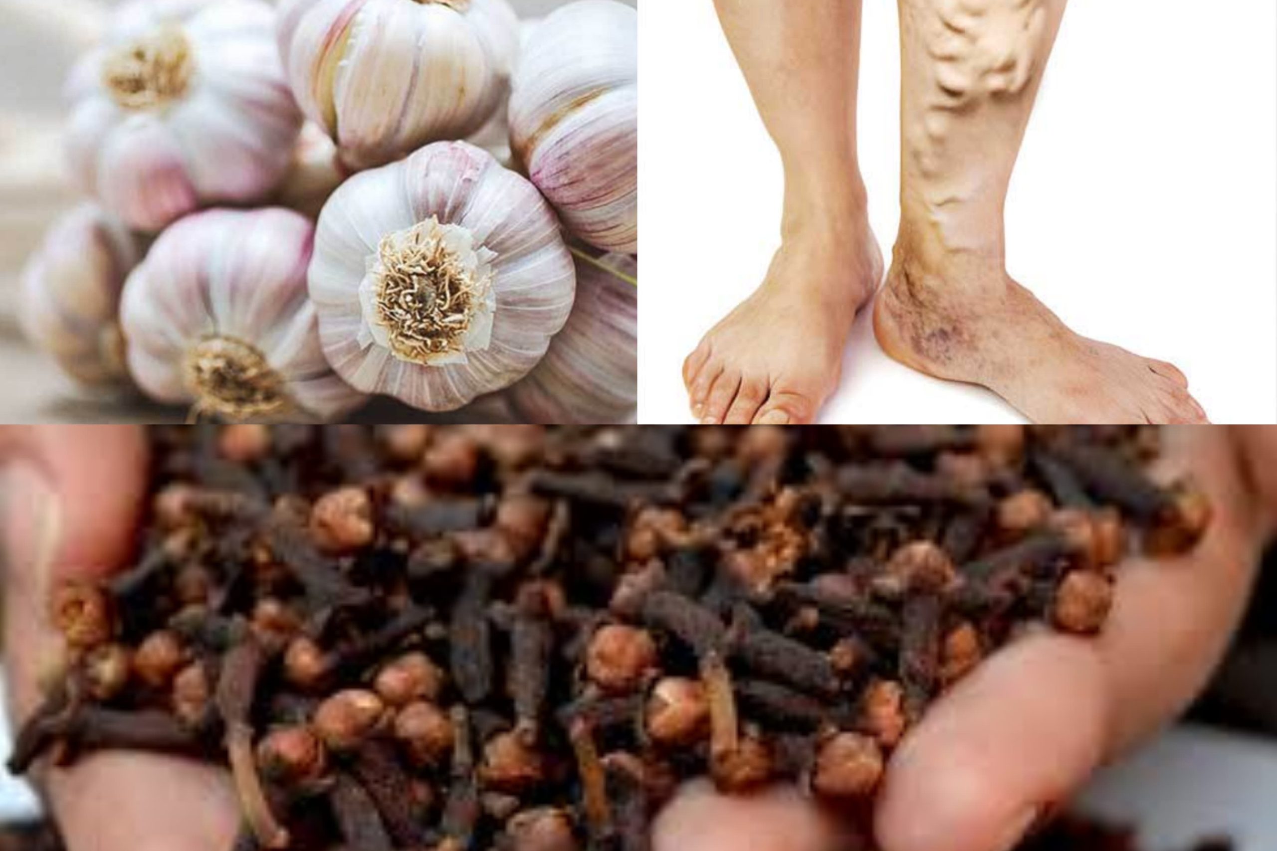 නහර ගැට ගැහෙනවට ආතරයිටිස් වලට හොඳම විසඳුම ඔයාලගේ ගෙදර කුස්සියේම තියෙයි කියලා මීට කලින් දැනගෙන හිටියේ නෑ නේද ? මෙන්න ඒ ගැන…