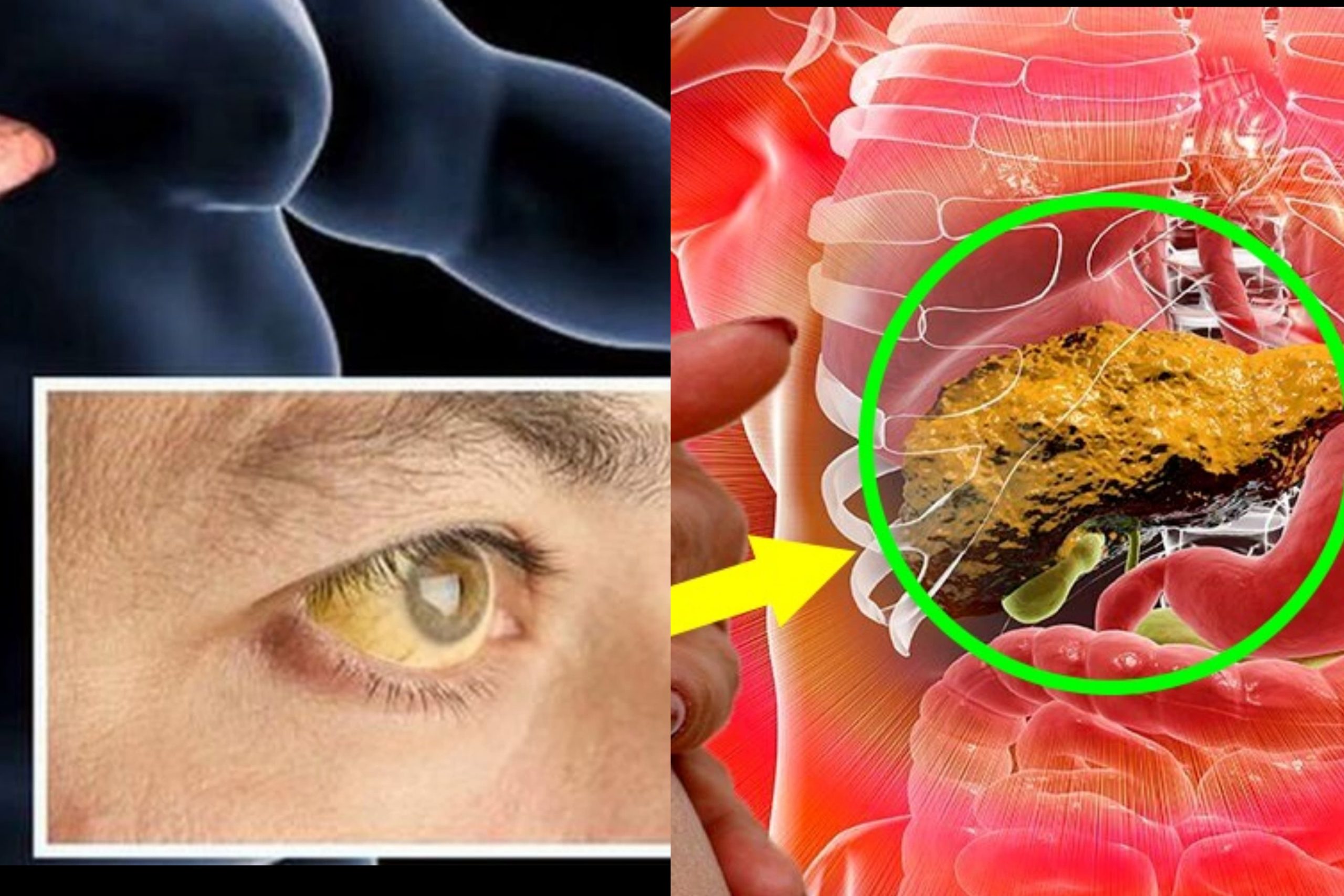 අක්මාවේ තෙල් තැම්පත් වෙලාද ? කල්තියා දැනගන්න පුලුවන් ලක්ෂණ මෙන්න