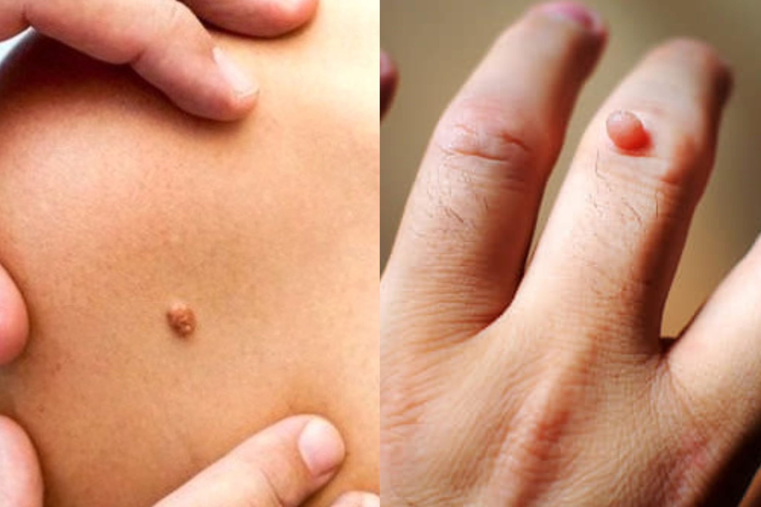 කරදරකාරී ඉන්නන් නැති කරන්න සරල ක්රම ටිකක් මෙන්න. ගෙදරදීම කරලා බලන්න