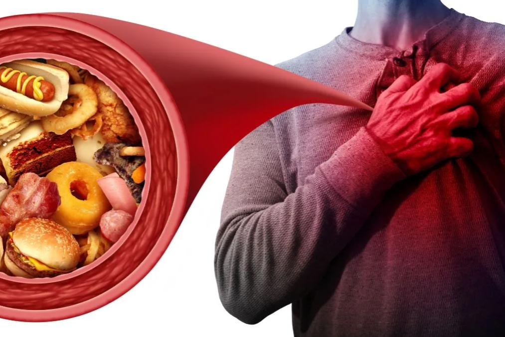 ස්වාභාවිකවම කොලෙස්ටරෝල් මට්ටම අඩු කරගන්නේ මෙන්න මෙහෙමයි..