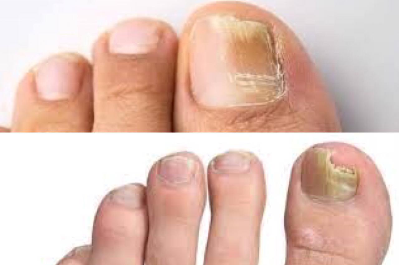 ඔයාගේ නියපොත්තටත් මෙහෙම දෙයක් වුනොත්, පාදයේ ලස්සන ගැන සැලකිලිමත් වෙන ඔබට මේ ලිපිය විශේෂයි