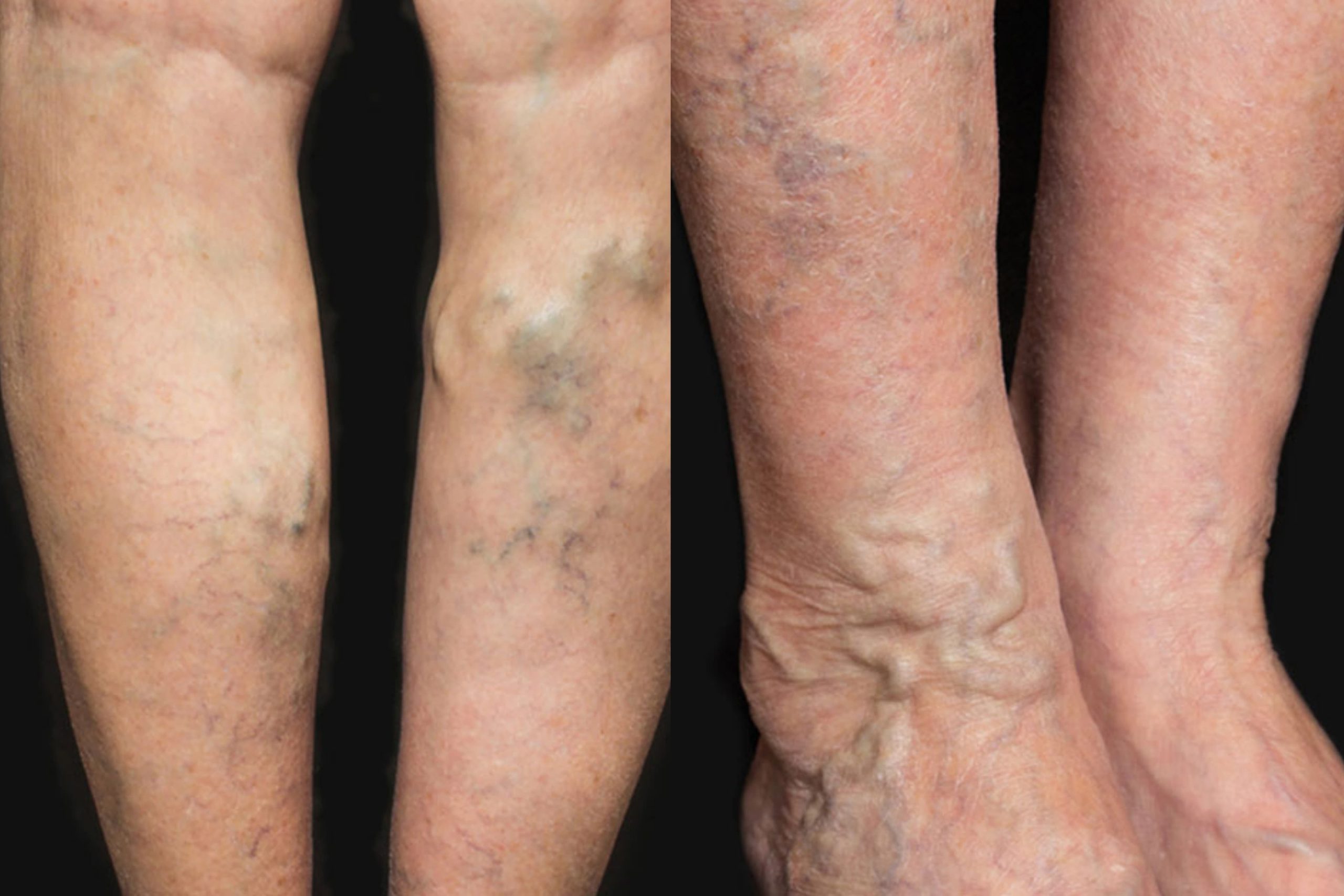 නහර ගැට ගැසීම කියන්නේ මේ තරම් රෝග ගොඩකට මූලික ලක්ෂණයක් කියලා මීට කලින් ඔයාලත් දැන සිටියාද