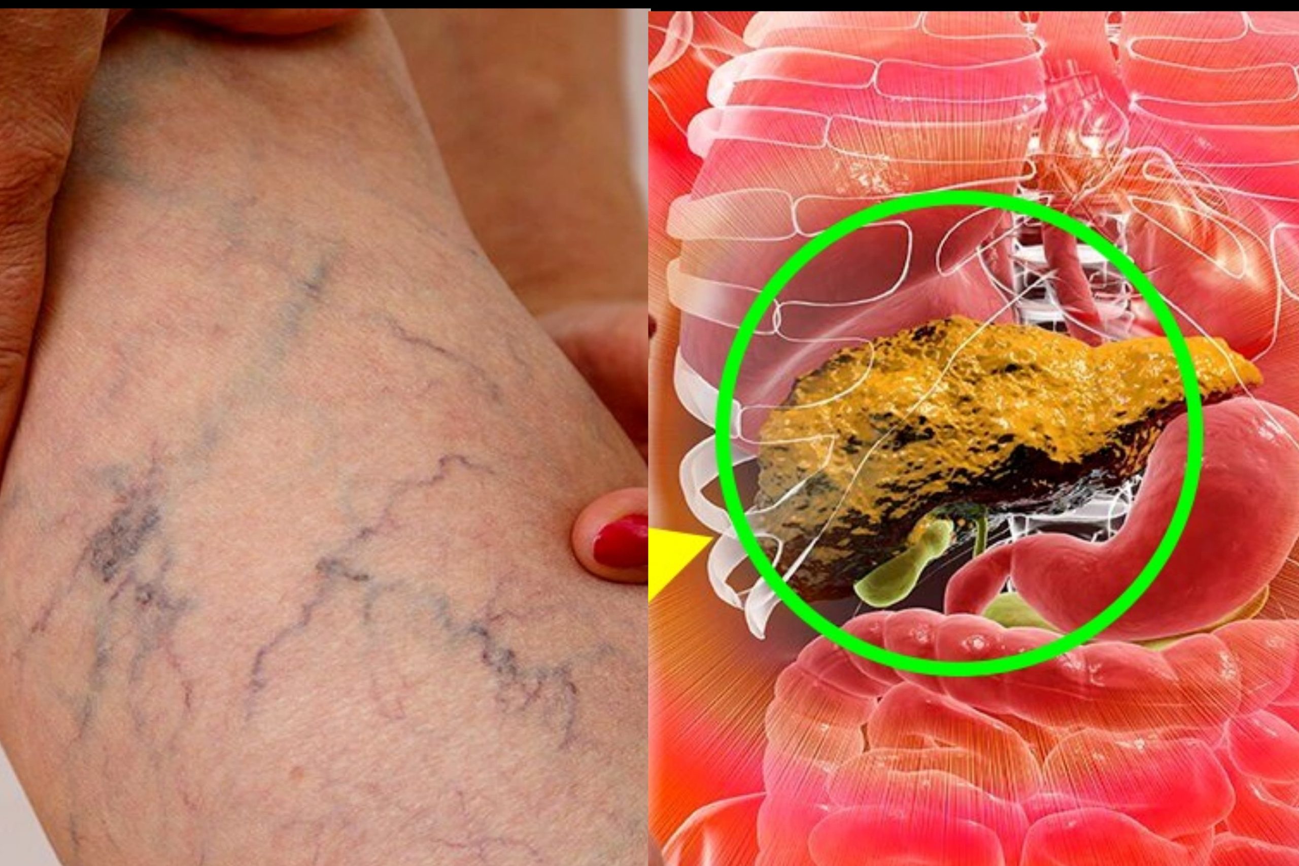 අක්මාවේ තෙල් තැම්පත් වී ඇති බව වේලාසනින්ම හදුනාගන්නේ මෙහෙමයි.