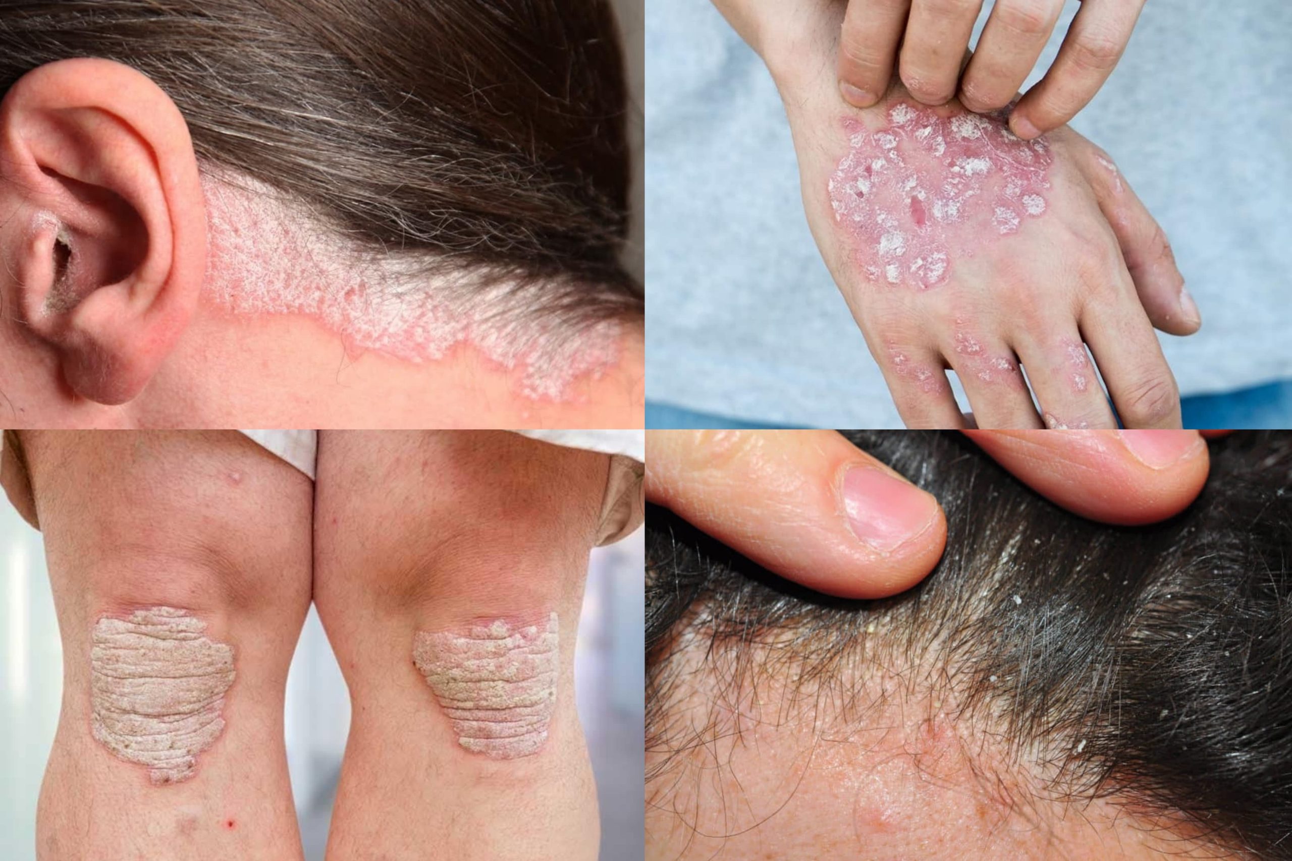 ඔබේ ශරීරය අවලස්සන කරන ‘ සොරයිසීස් ‘ ගැන හරියටම දැනගන්න