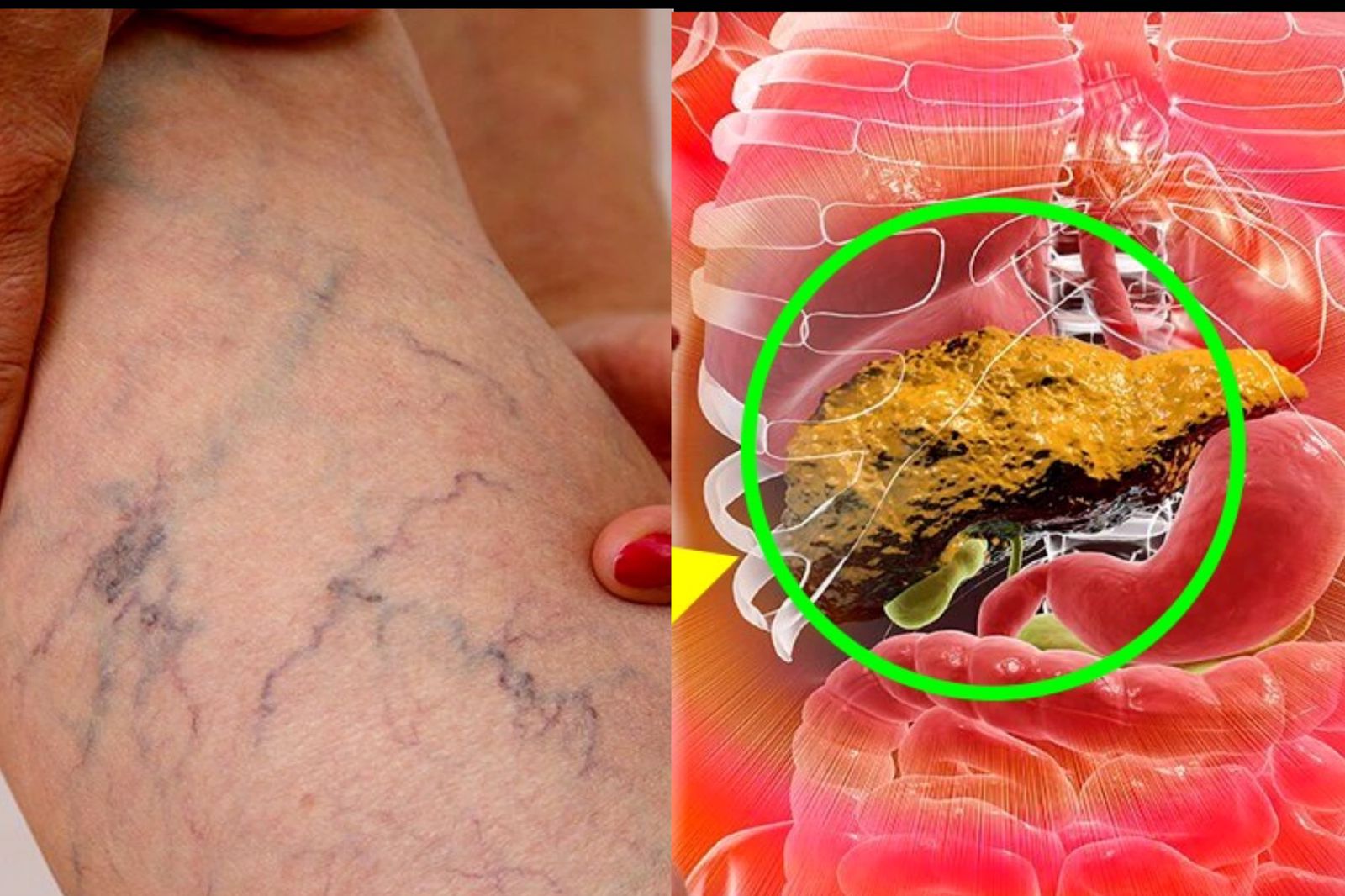 ඔයත් කොලෙස්ටරෝල් නිසා බයෙන් හිටියාද..? මෙන්න ලෙඩේ මට්ටු කරන ඖෂධ ගුලිය…