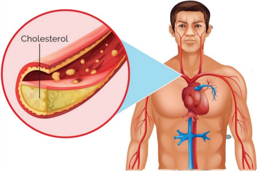 ඔයාටත් කොලෙස්ටරෝල්ද ? ලෙඩේ වැඩි වෙන්න කලින් හරියටම දැනගන්නේ මෙහෙමයි !