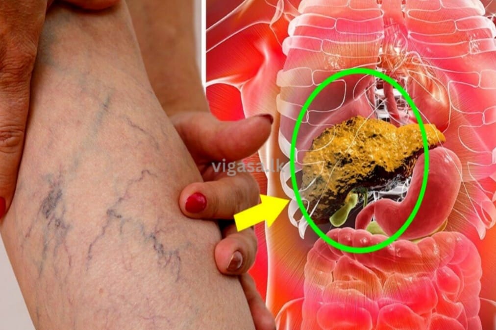 දන්නවද ? මේ ආහාර කනකොට අක්මාවේ තෙල් නිකන්ම දියවෙලා යනවා කියලා ?