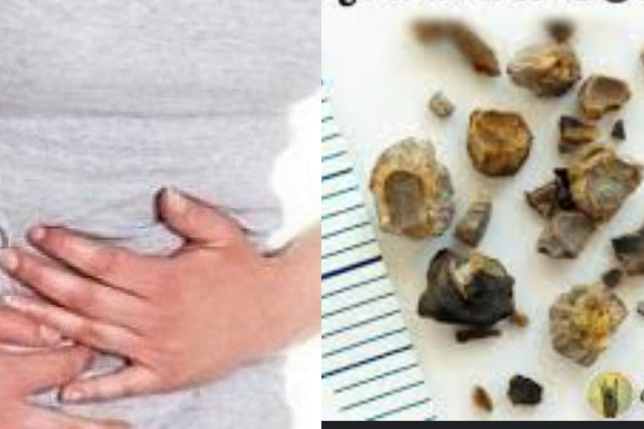 මුත්රා ගල් සහ වකුගඩුවල ගල් හැදෙන්නේ ඇයි කියලා දැනගෙන හිටියද?