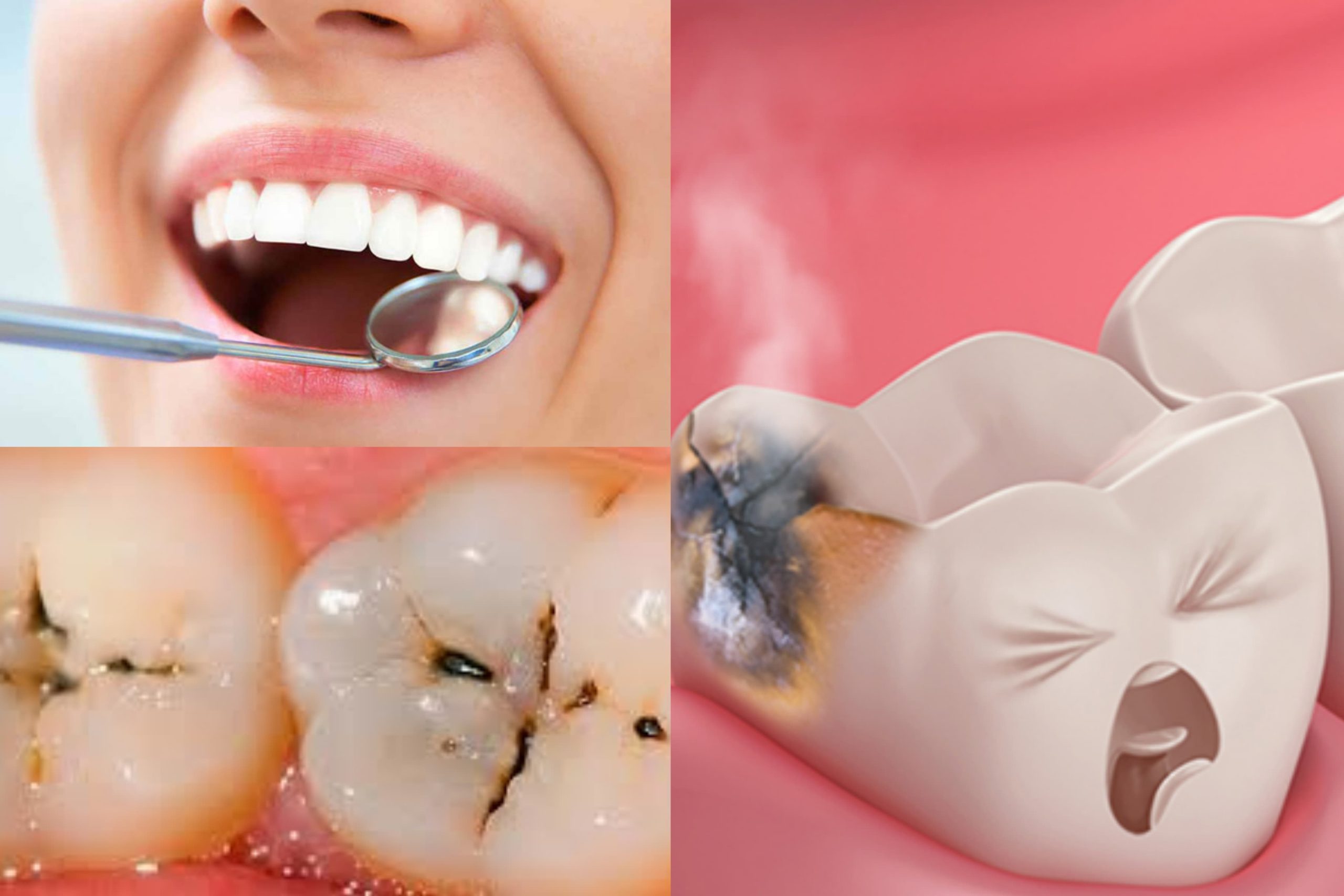 දත් කුහර ඇති වෙන්න මේකත් එක හේතුවක් වෙන්න පුළුවන්.. දත් දෙපළ ගැන සැලකිලිමත්වන කවුරුත් මේ ගැන දැනුවත් වෙන්න..