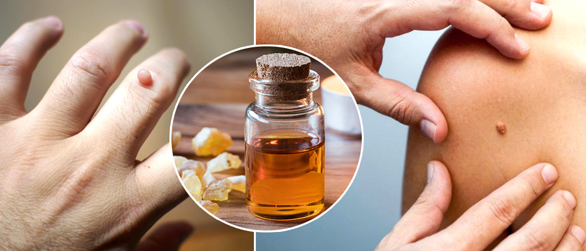 කරදරකාරි ඉන්නන් නැති කරගන්න සරල ක්රම ටිකක් මෙන්න