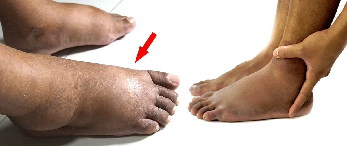 ඔබේ ඉදිමුණු පාද වලින් පෙන්වන නිධංගත සැඟවුණු රෝග රැසක් මෙන්න