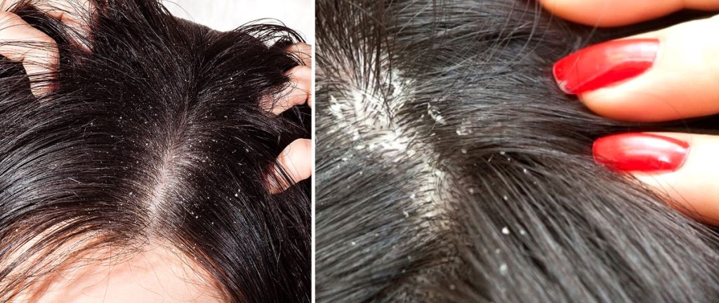 ඔයත් මේ නිසා වද විදිනවාද ? හිශොරි කරදරේ නැත්තටම නැති කරගන්න මෙන්න සුපිරිම විදිහ