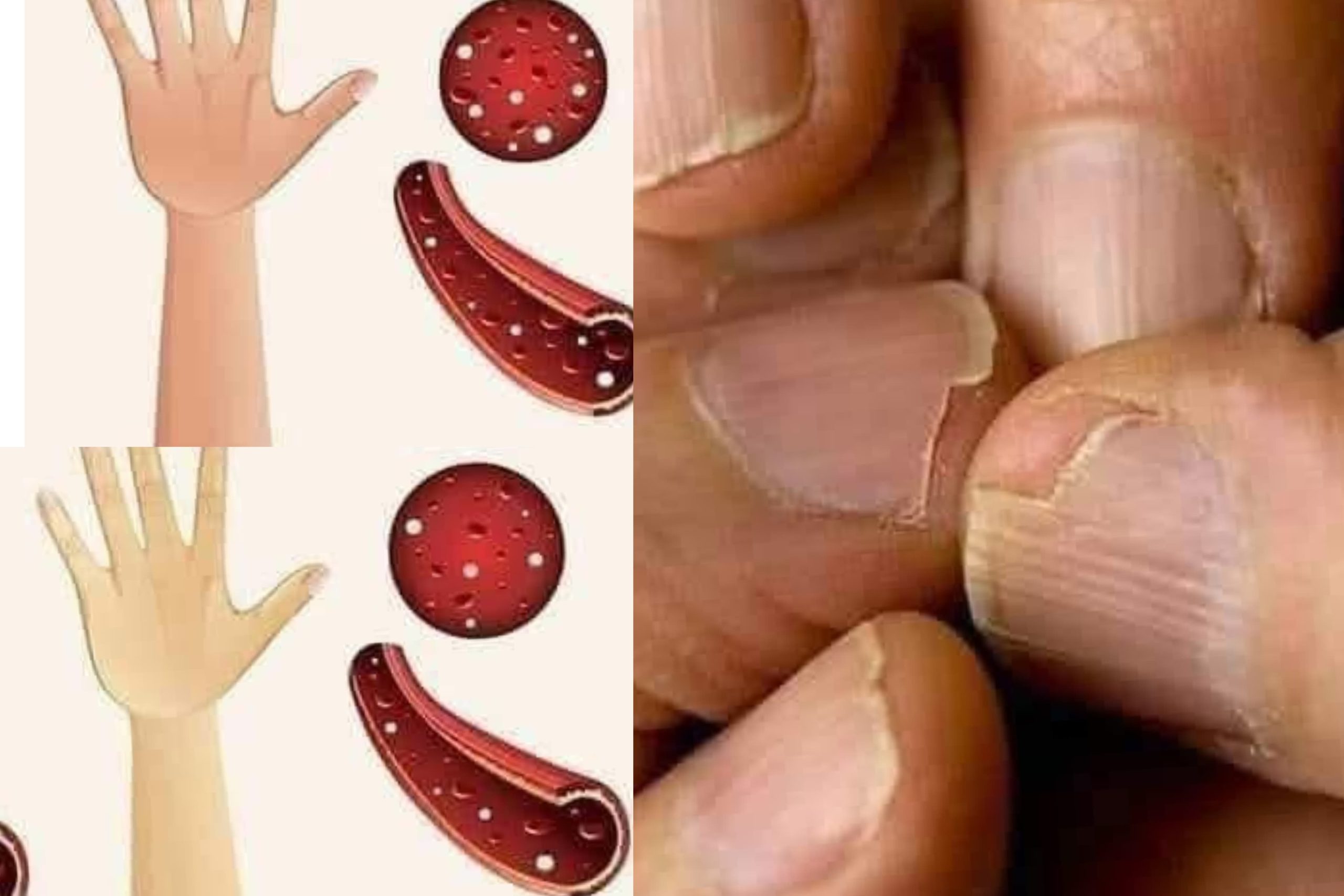 ඔබේ සිරුරෙත් යකඩ හොඳටම අඩු වෙලාද ? මේ ලක්ෂණ තියෙයි නම් සැලකිලිමත් වෙන්න