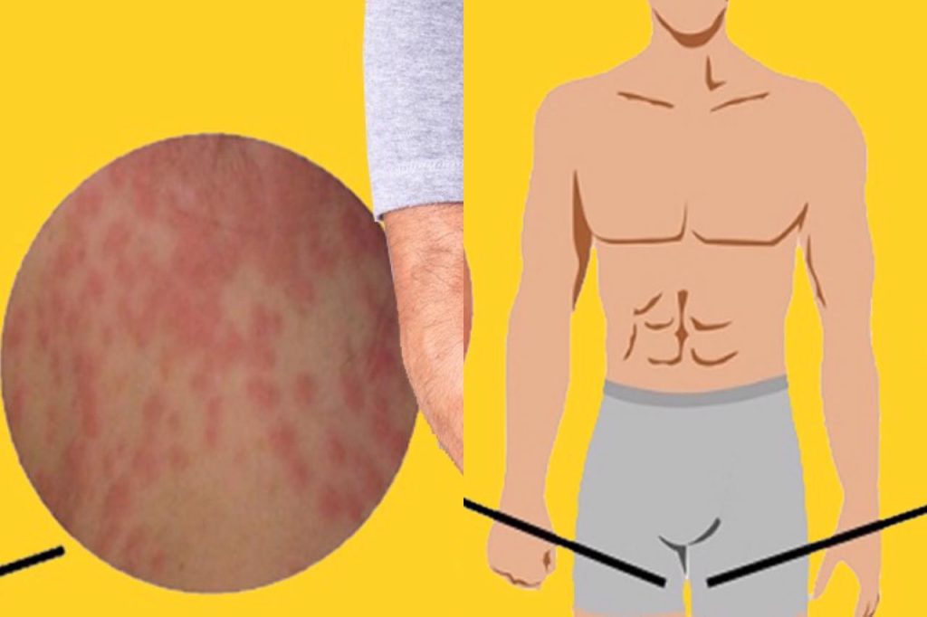 ඉකිලි කැසීමේ රෝගය නිට්ටාවටම සුව කරගන්න සුපිරිම ක්රම 15ක් මෙන්න. කාන්තා පිරිමි දෙපාර්ශ්වයටම විශේෂයි !