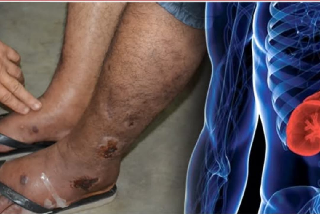 මේ රෝග ලක්ෂණ තියෙනවනම් බලන්න ඉන්න එපා… වකුගඩු රෝග ආරම්භයේ ඇතිවන රෝග ලක්ෂණ මෙන්න…