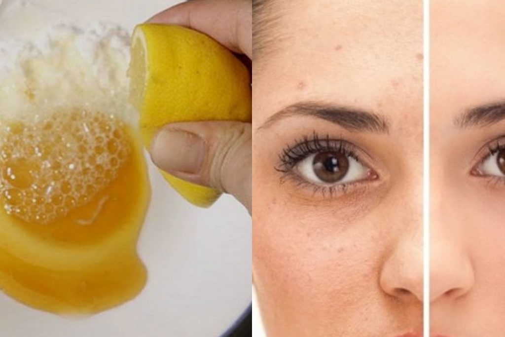 කුරුළෑ , තුවාල කැළැල් නිසා ඔබත් දුක් වුනාද ? එහෙනම් ඒ දුක් වුනු කාලේ ඉවරයි. මෙන්න තුවාල කුරුළෑ ළප කැළැල් මකන සාර්ථකම ප්රතිකාරයක්..!