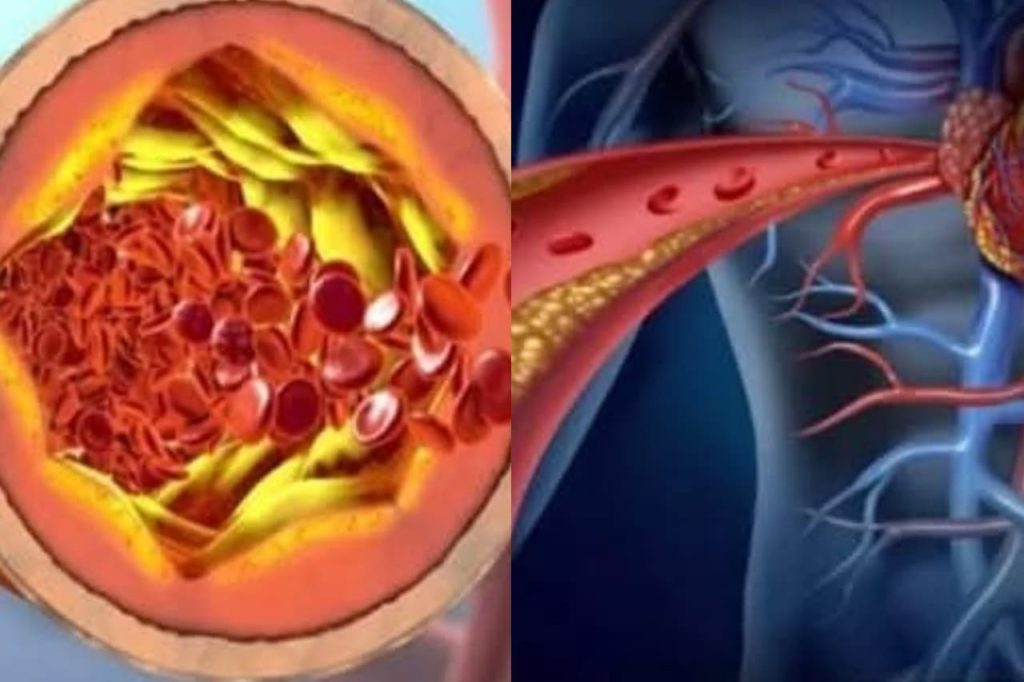 කොලෙස්ටරෝල් වලින් හැමදාටම නිදහස් වෙන්න පුළුවන් මේ ප්‍රතිකාරය හරියට කළොත්…