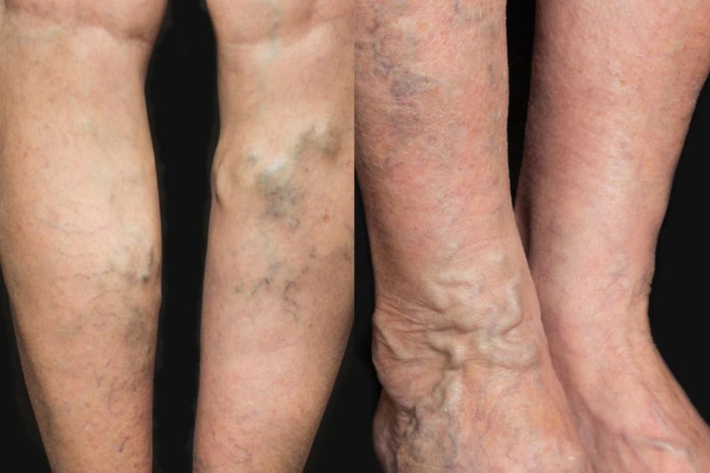 ඔයාගෙත් නහර ගැට ගැහෙනවද ? එහෙමනම් බල බල ඉන්න එපා… දරුණු රෝගයක ආරම්භයක් වෙන්නත් පුලුවන් !