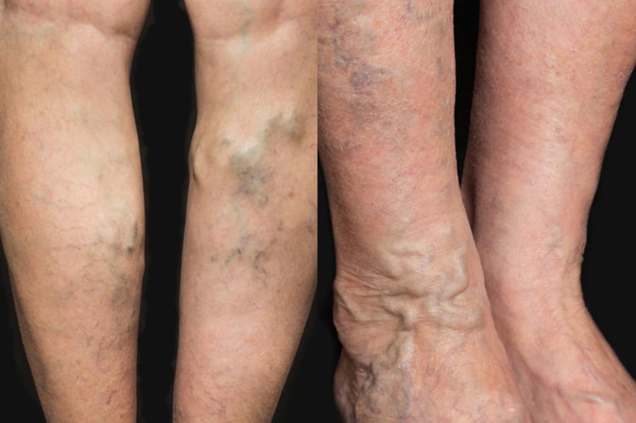 ඔයාගෙත් නහර ගැට ගැහෙනවද ? එහෙමනම් බල බල ඉන්න එපා… දරුණු රෝගයක ආරම්භයක් වෙන්නත් පුලුවන් !