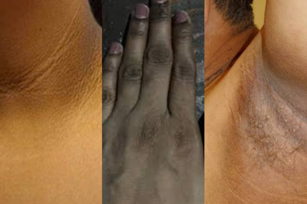 ඇඟිලි පුරුක්, බෙල්ල, ඉකිලි, කිහිලි කළු වෙලානම් මෙන්න… නිවසේදීම පහසුවෙන්ම කරන්න පුළුවන්…