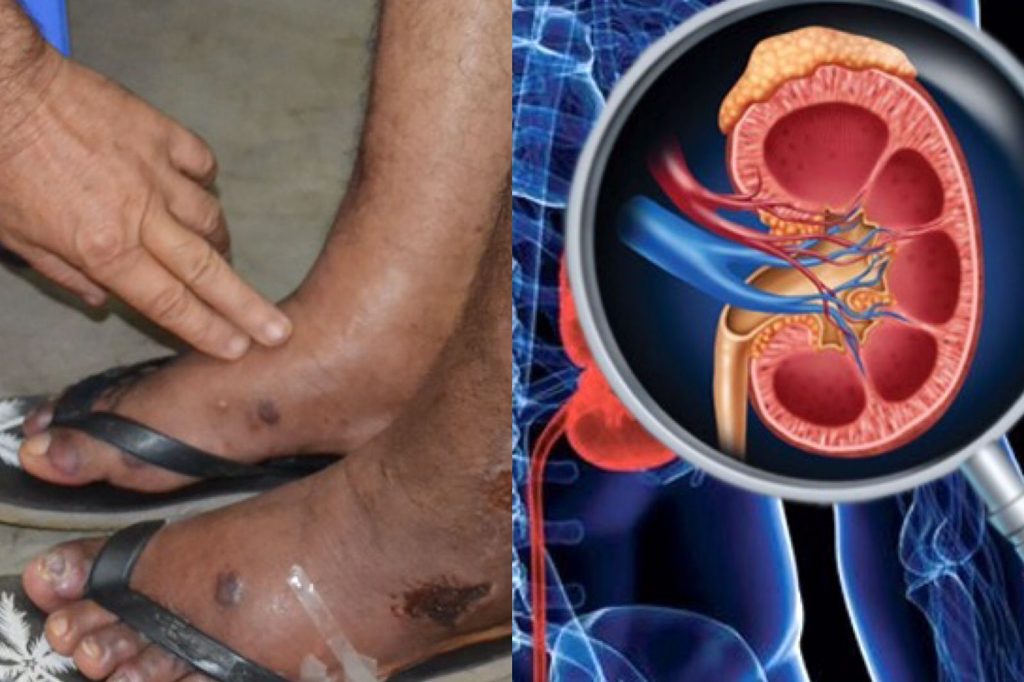 වකුගඩුවල ගල් හටගෙන ඇති බවට හඟවන රෝග ලක්ෂණ…