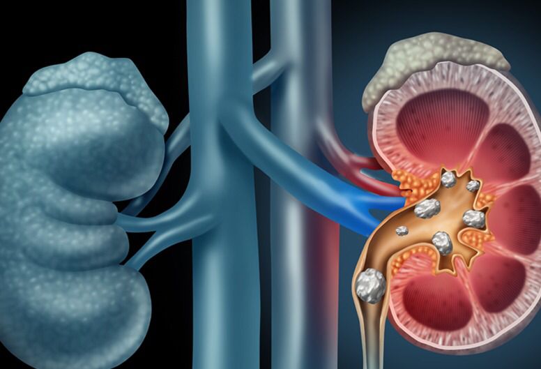 මේ රෝග ලක්ෂණ තියෙනවනම් බලන්න ඉන්න එපා… වකුගඩු රෝග ආරම්භයේ ඇතිවන රෝග ලක්ෂණ මෙන්න…
