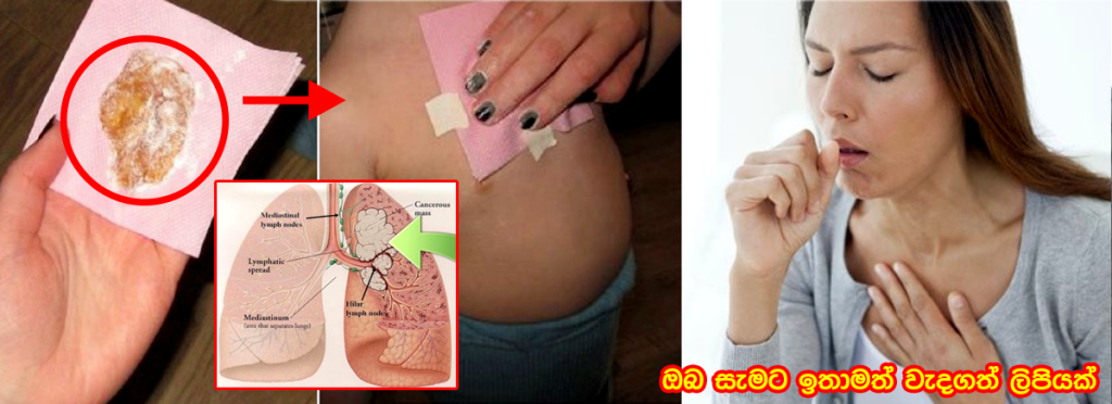 බාල මහළු කොයි කාටත් පපුවේ සේම එක රැයෙන් හොඳ කරගන්න මෙන්න ප්‍රතිකාරය