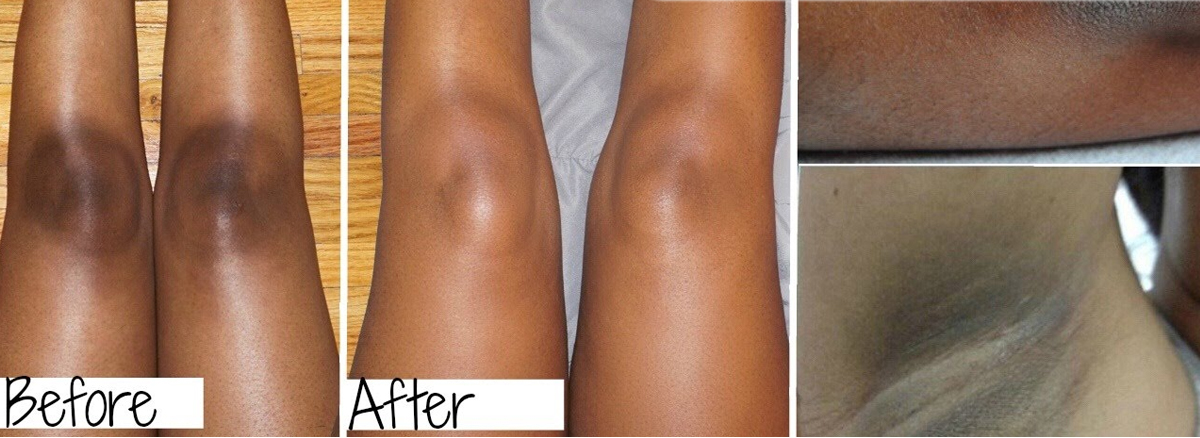 දණහිස් කළුවීම නිසා කැමැති විදියට ඇඳුම් අඳින්න බැරුව දුක් වෙනවද? එහෙනම් මෙන්න ඔබට වැදගත් ලිපියක්