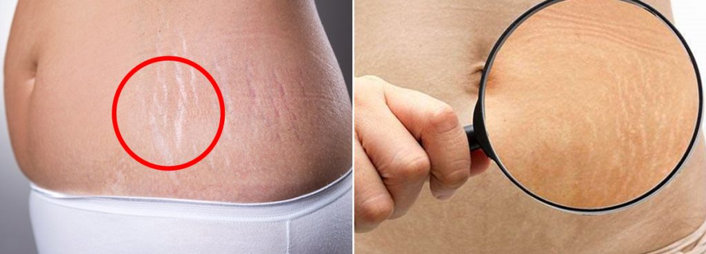 උදරයේ සම මත ඇතිවන ඉරි ඇඳි සලකුණු (Stretch Marks) ස්වභාවිකවම ඉවත් කරන සරල ක්‍රම ටිකක් මෙන්න
