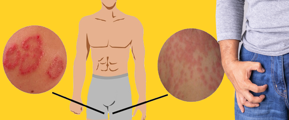 ඔබත් ඉකිලි කැසීමේ රෝගයෙන් පෙලෙන අයෙක් නම් නිට්ටාවටම හොද කරගන්න ක්රම 15ක් මෙන්න