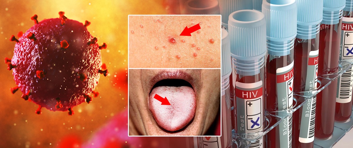 සමාජ රෝග හා ඒවායේ රෝග ලක්ෂණ මෙන්න – මේ වගේ රෝග ලක්ෂණ ඔබටත් තියෙනවද බලන්න