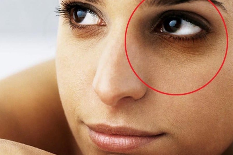 ඔයාගෙත් ඇස් යට කළු වෙලාද ? බය වෙන්න එපා.. මෙන්න හරිම ප්‍රතිකාර
