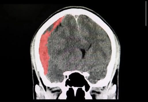 අවධානය යොමු කරන්න..ඔබත් වයස අවුරුදු 40 පසු වෙන කෙනෙක් නම් අනිවාර්යයෙන්ම මේ රෝගය ගැන අදම දැනුවත් වෙන්න.