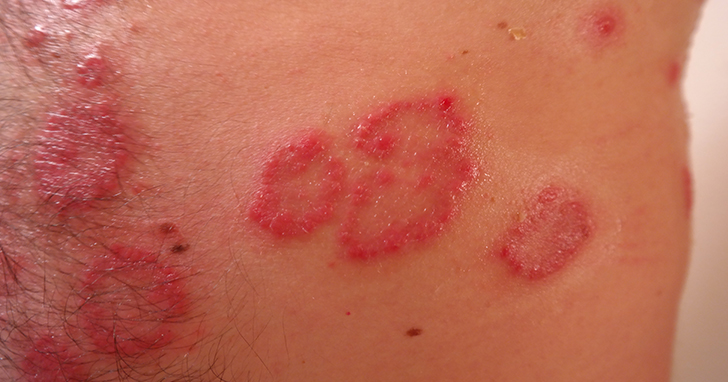 90% ම නොසලකා හරින පි.ළිකා රෝගයේ රෝග ලක්ෂණ 7 ක් මෙන්න