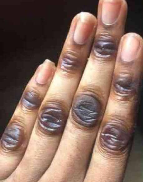 ඔබේ ශරීරයේ මේ මේ ස්ථානවල ලප දැකගන්න ලැබෙනවා නම්, සමහරවිට එය පිළිකාවක ලක්ෂණයක් වෙන්න පුළුවන්..