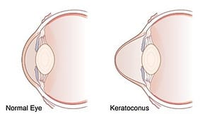 මේ දිනවල පවතින පෙනීම බොද කරන කෙරටොකෝනස් රෝගයක් ගැන ඔබත් අනිවාර්යයෙන් දැනුවත් වෙන්න..
