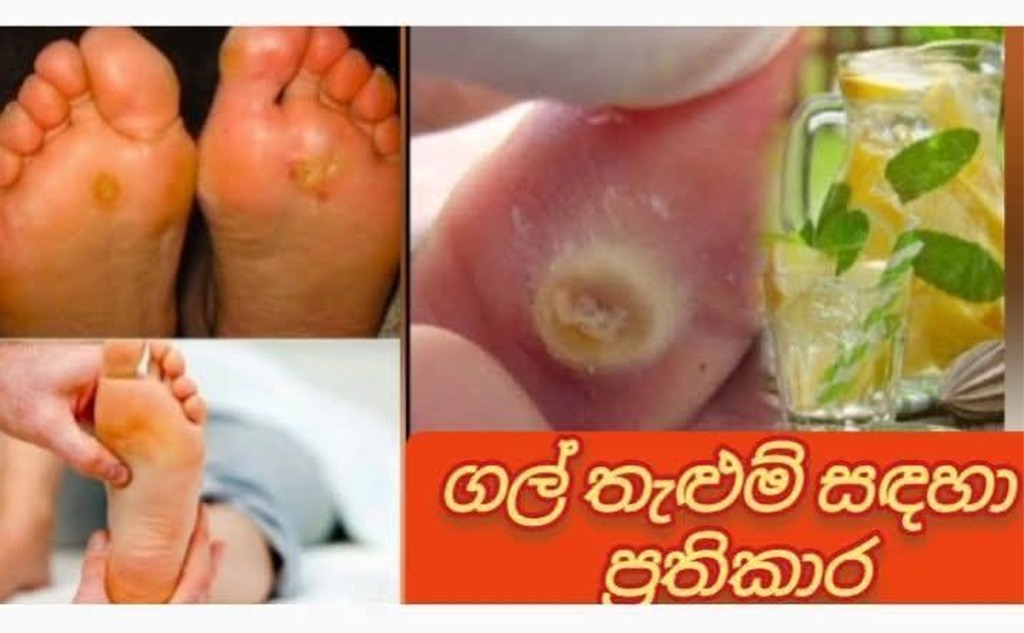 එක රැයෙන් ගල් තැලුම් නැත්තටම නැති කරගන්න… ගල් තැලුම් තියෙනවා නම් අදම මේ විශ්මිත ප්රතිකාරය කරලා බලන්න
