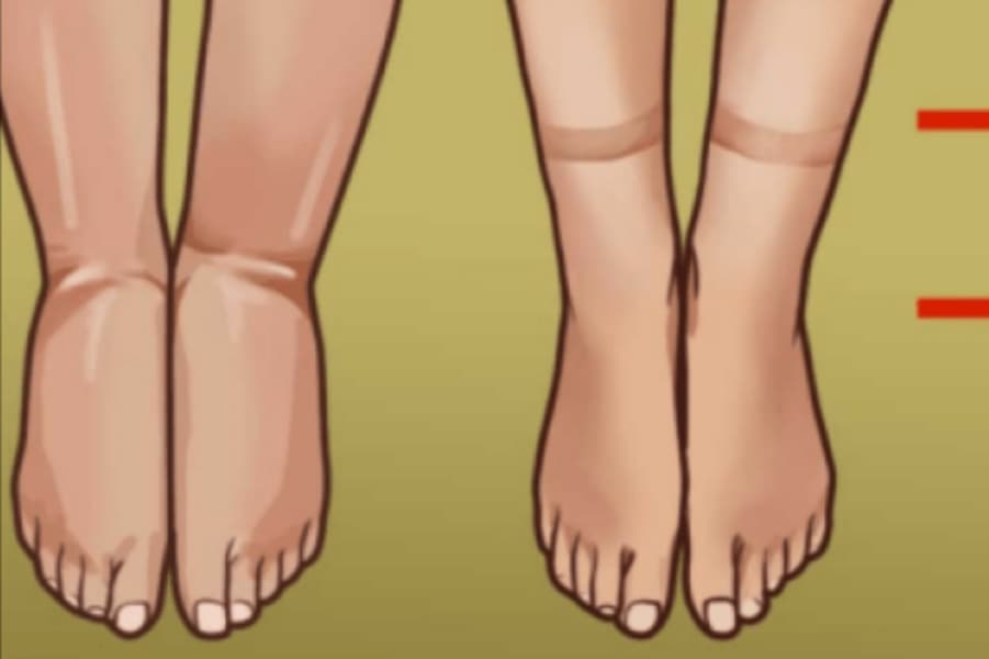 දෙපාවල වෙනස්කම් වලින් හෙලිවෙන මේ බරපතල රෝග ගැන ඔයත් දැනුවත්ද ?