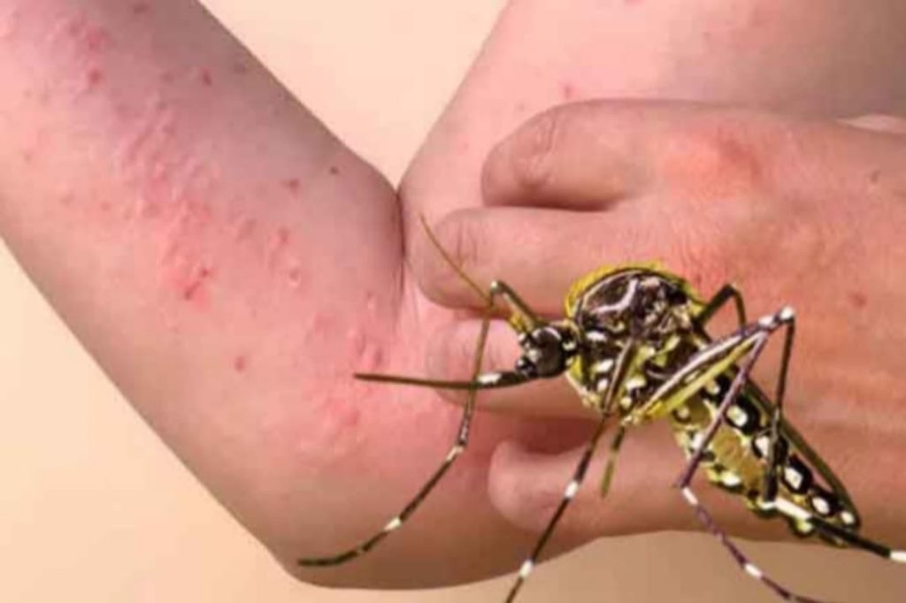 මේක නම් හදාගන්න එපා. හැදුනොත් මාස ගාණක් විඳවන්න වෙයි. මේ රෝග ලක්ෂණ තියෙයි නම් ඔයාටත් චිකන්ගුන්යා වෙන්න පුළුවන්…!