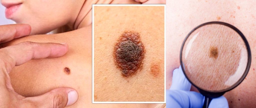 ඔබේ උපන් ලපය පි.ළිකාවක්ද කියලා හරියටම දැන ගන්නේ මෙහෙමයි.