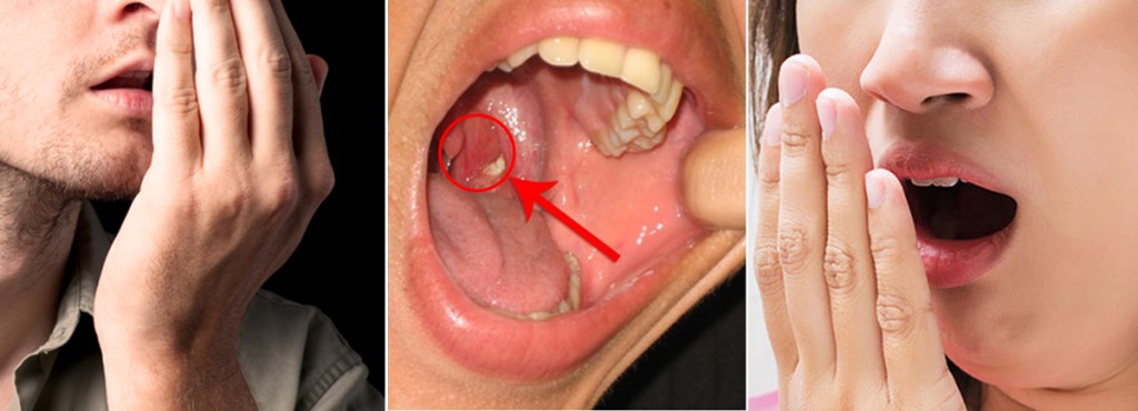 ඔබේ කට ගඳ ගහන එකට හේතුව මෙන්න, අනිවාර්යෙන් බලන්න.