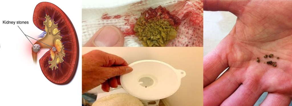 ගෙදර දීම සාදාගත හැකි වෛද්යවරුන් පවා පුදුමකර වකුගඩුවල ගල් ඉවත්කරන විශ්මිත පානය.