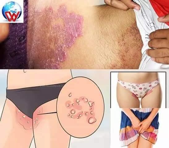 ඉකිළි කැසීම නිට්ටාවටම සුව කරන අත්බෙහෙත් මෙන්න..