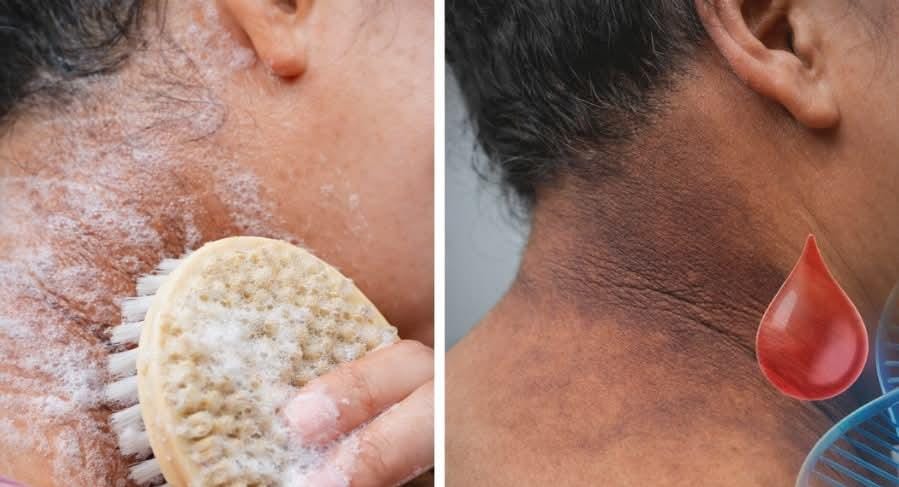 නව සොයාගැනික්මක්..බෙල්ල වටේ කළු වෙලාද? සබන් දාලා කොච්චර ඇතිල්ලුවත් යන්නෙ නැද්ද? ඒ කුණු නෙවෙයි…ඒ තමයි දියවැඩියාවේ මුල්ම රෝග ලක්ෂණය …