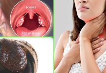 වේදනා විඳන සෙම්ගෙඩි දවසින් සුව කරන ස්වභාවික වට්ටෝරුවක්