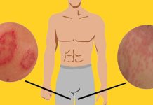 ඉකිලි කැසීමේ රෝගය නිට්ටාවටම හොඳ කරගන්න ක්රම 15 ක් මෙන්න.