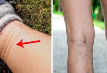 ඔයාටත් අධි රුධිර පීඩනය තියෙයිද කියලා මේස් පැලදීමෙන් පස්සේ කකුලේ ඇති වෙන ලකුණු වලින් හොයාගන්න පුළුවන් !