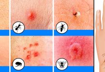 සතෙක් දශ්ඨ කලොත් දශ්ඨ කල සතා හදුනාගන්න ලේසිම ක්රමය මේකයි..