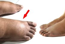 පාද ඉදිමිලාද ? හදවතේ ගැටලු, වකුගඩු ගැටලු, අක්මාවේ ගැටලුවක් වෙන්නත් පුළුවන් ! ඉදිමුණු පාද තුලින් පෙන්වන සැඟවුණු රෝග රැසක් මෙන්න.